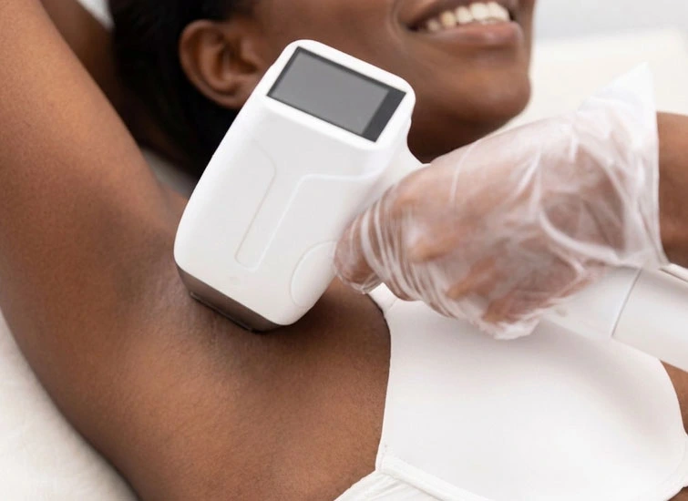 laser hair removal for dark skin